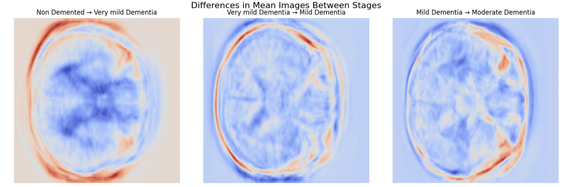 Difference in mean images between consecutive Alzheimer's stages