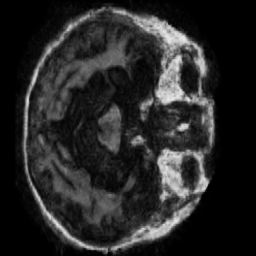Generated Moderate Dementia scan